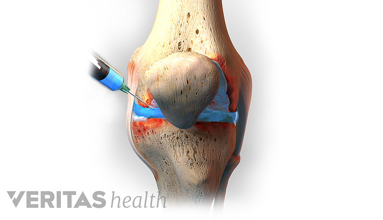 Medical illustration of needle being injected into the knee joint.