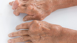 Hand with rheumatoid arthritis in the small joints.