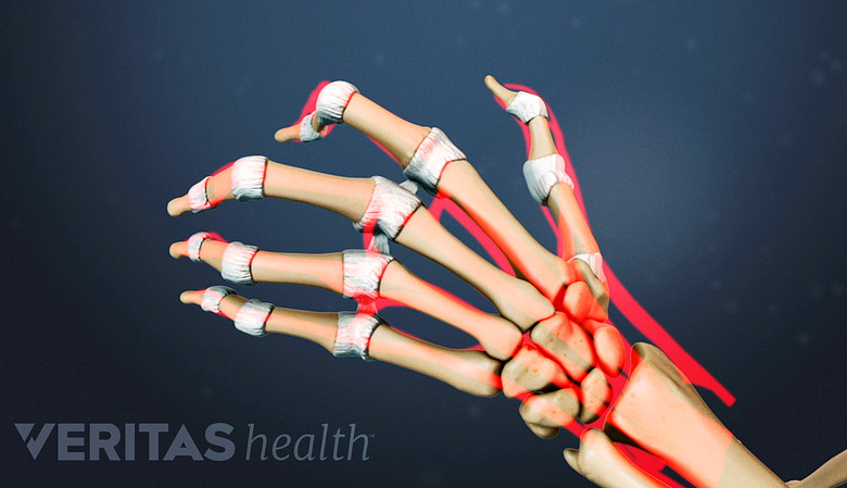 Rheumatoid Arthritis in the hands