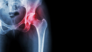 Xray showing osteoarthritis in the hip joint.