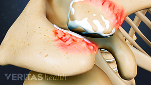 Bone spurs can develop at the AC joint due to friction as a result of degenerated cartilage.