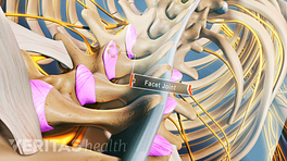 Anterior view of Ankylosing Spondylitis labeling the facet joints.