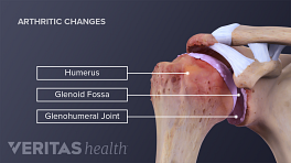 Illustrated skeleton showing arthritis in the shoulder