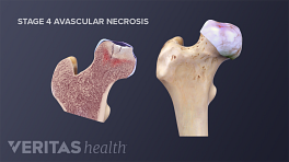 Avascular necrosis is a bone disorder causing decreased blood and nutrient supply and eventual bone collapse in the affected area.