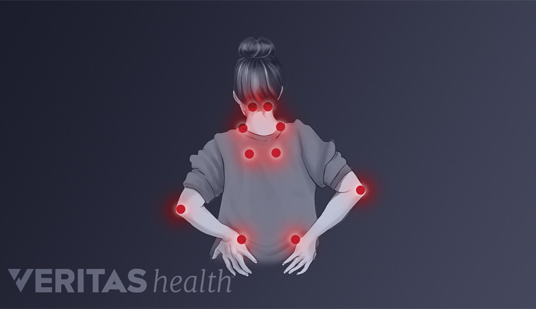 Woman experiencing painful pressure points from fibromyalgia.
