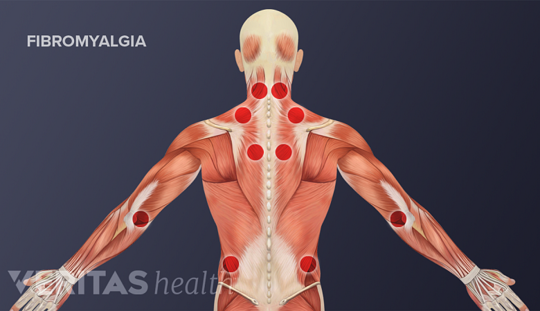 Trigger points on the back from fibromyalgia.