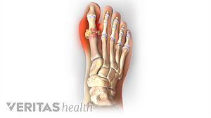 Illustration of the foot showing pain around the big toe as a result of gout