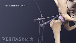 Illustration showing instrumentation for a hip replacement surgery