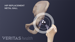 Illustration of a hip replacement, highlighting the metal ball that goes into the hip socket