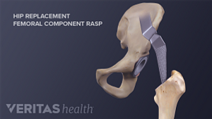 Illustration of a hip replacement with a femoral component rasp