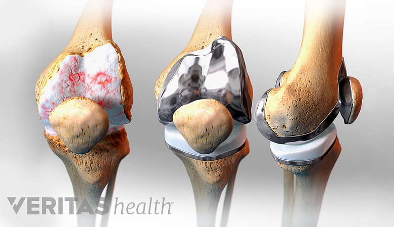 Medical illustration of an arthritic knee joints a front and side view of a replaced knee joint and a re