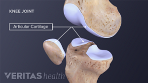 Medical illustration of normal articular cartilage in the knee