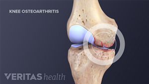 Medical illustration of inflammation in the knee joint