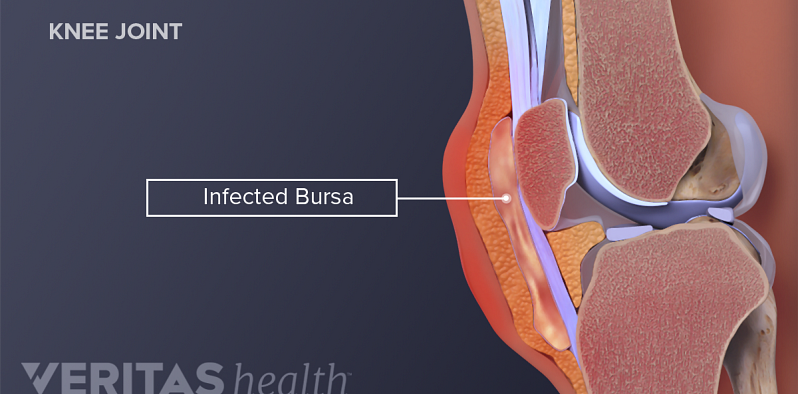 Medical illustration showing an infected bursa