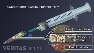 Diagram showing the components of Platelet-Rich Plasma Therapy including platelet poor plasma, platelet rich plasma and red blood cells.