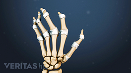 Illustrated skeletal view of a hand with rheumatoid arthritis deformities