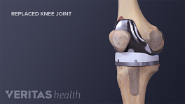 Medical illustration of a completed knee replacement labeling tibia and femur