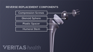 Illustration of the reverse replacement components of shoulder replacement surgery. Glenoid sphere, compression screws, plastic spacer and humeral stem are labeled.