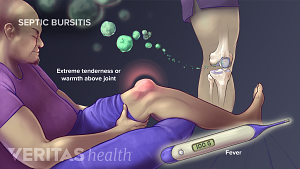 Illustration of septic bursitis showing a high fever and extreme tenderness or warmth above joint.