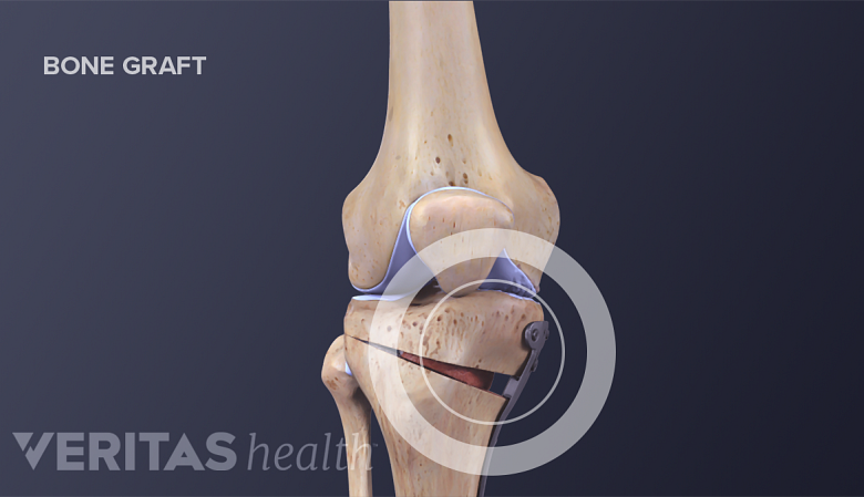 Medical illustration showing parts of the bone that are removed and bone grafts added during a tibial osteotomy.