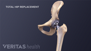 Hip joint showing joint replacement hardware.