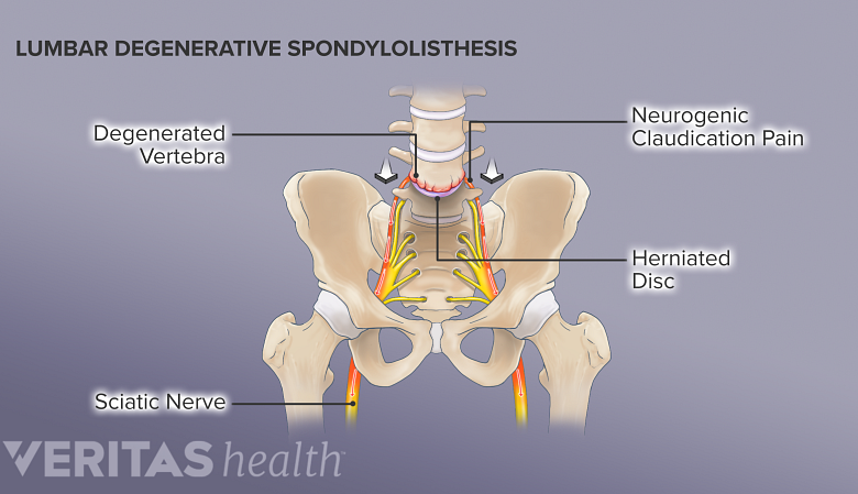 Illustration degenerative spondylolisthesis in the L4-L5 spinal segment causing neurogenic claudication pain.