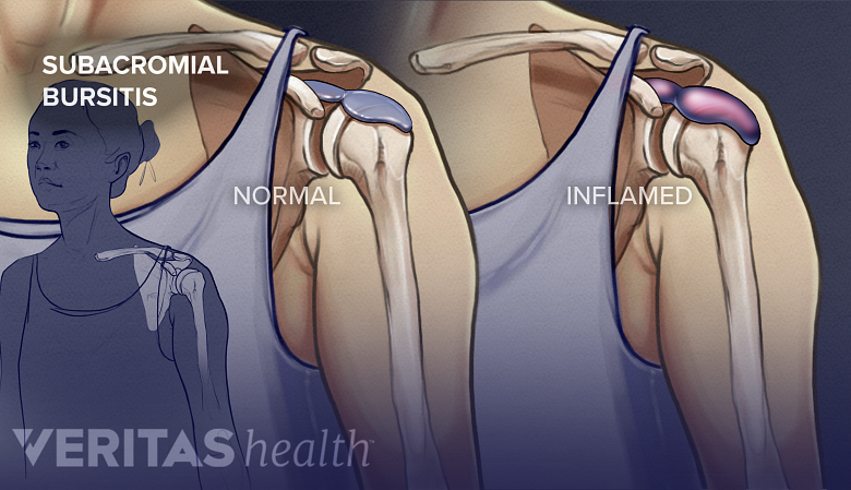 Anterior view of a normal shoulder joint and a joint with a bursa.