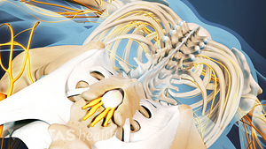 Ankylosing spondylitis in the lumbar spine.